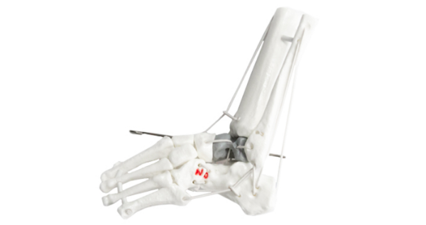 Vertical Talus Child Right